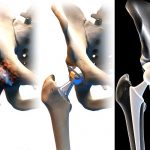 Things to Do Before Hip Replacement