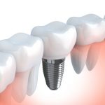 Points to Consider Before Having a Dental Implant Points to Consider Before Having a Dental Implant