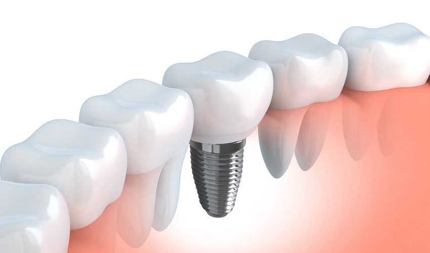 Points to Consider Before Having a Dental Implant